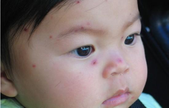 水痘可以吃蒲瓜,天然食疗新选择